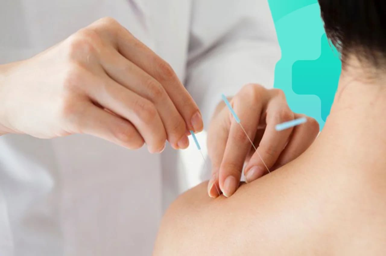 Châm cứu