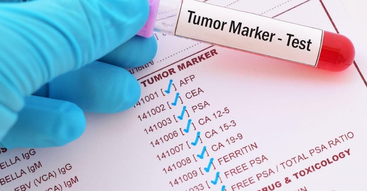 Marker ung thư buồng trứng: Các chỉ số quan trọng cần biết