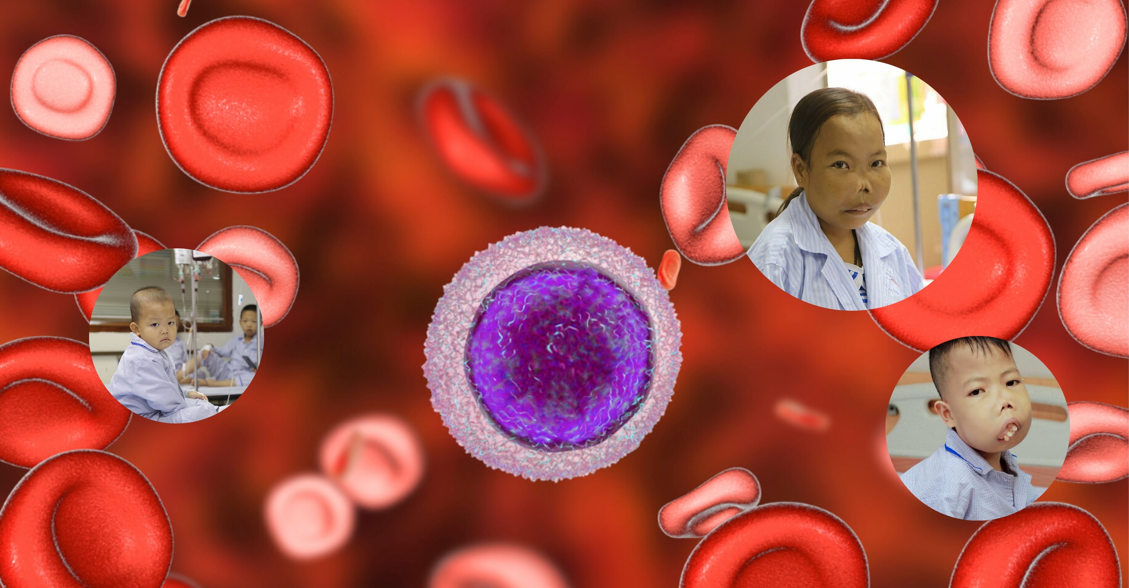 Tuổi thọ của người bị bệnh Thalassemia thể nhẹ là bao nhiêu lâu?