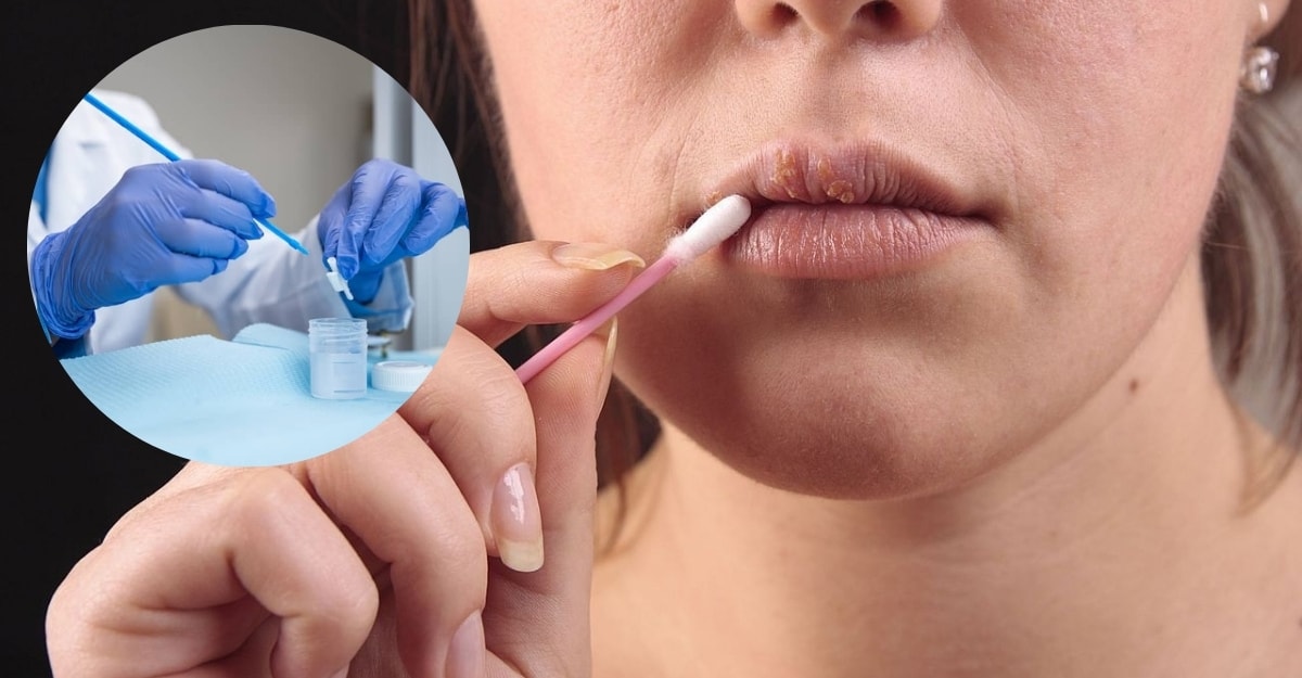 Xét nghiệm Herpes: Phương pháp, quy trình và cách đọc kết quả
