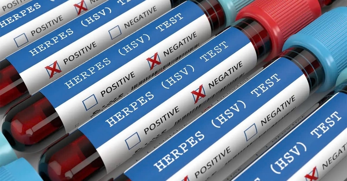 Xét nghiệm HSV: Phương pháp chẩn đoán bệnh Herpes chính xác