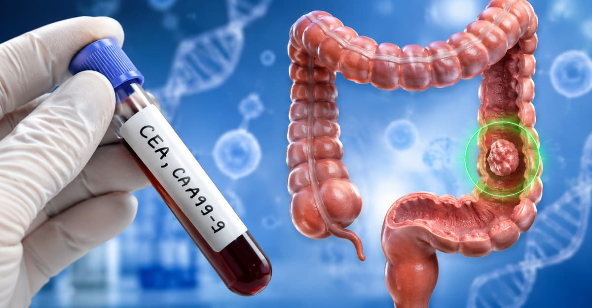 Giải đáp: Thực hư xét nghiệm máu phát hiện ung thư đại tràng?