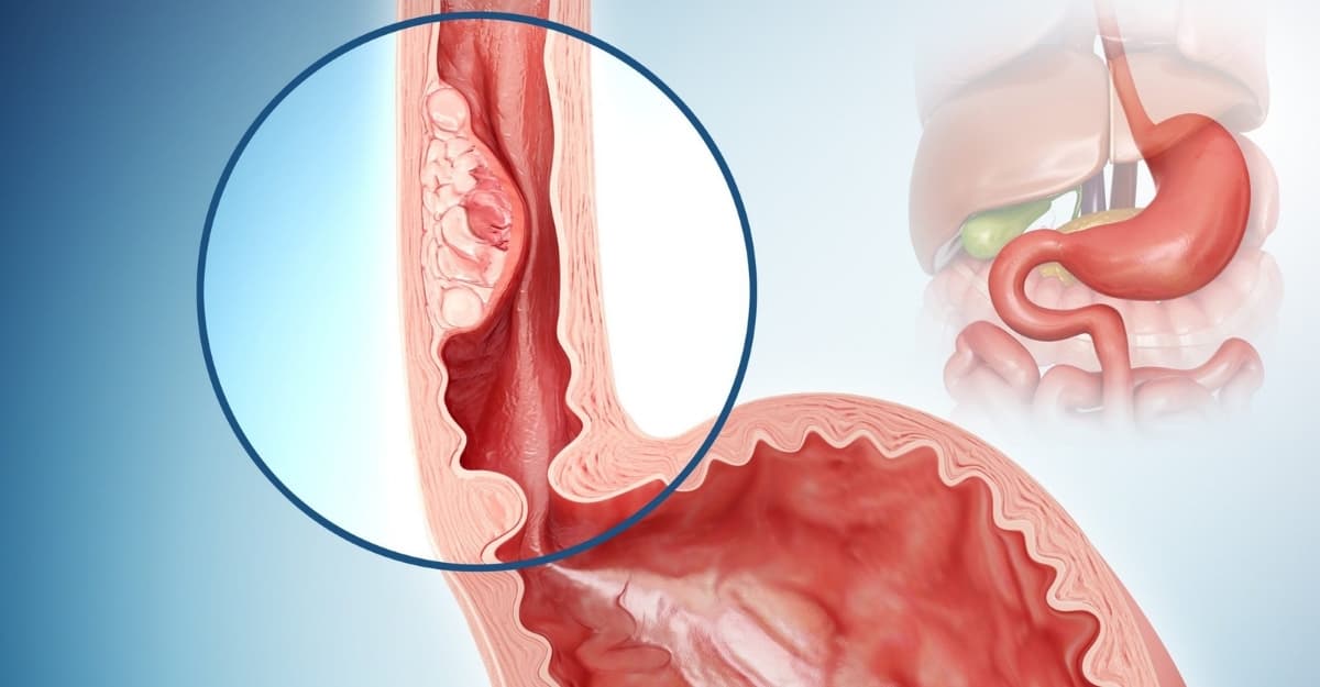Ung thư thực quản có di truyền không và các yếu tố nguy cơ