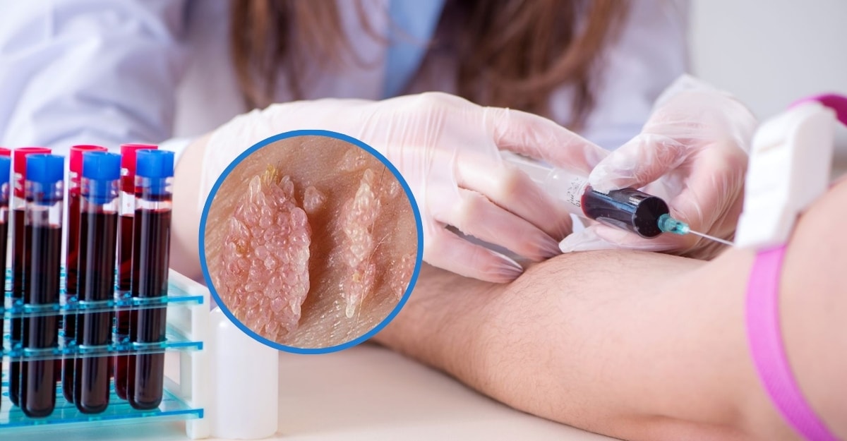 Giải đáp: Xét nghiệm máu có phát hiện sùi mào gà không?