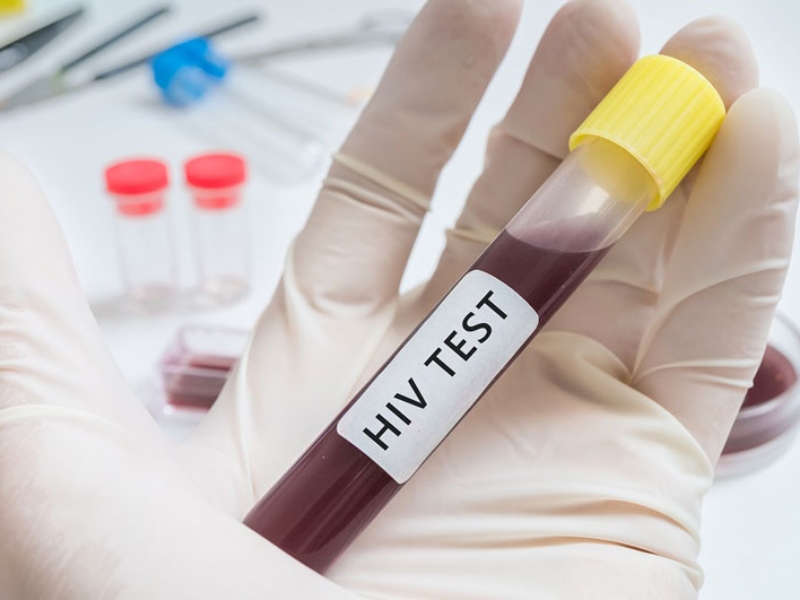Bác sĩ có thể chỉ định xét nghiệm tải lượng HIV để theo dõi hoạt động của virus