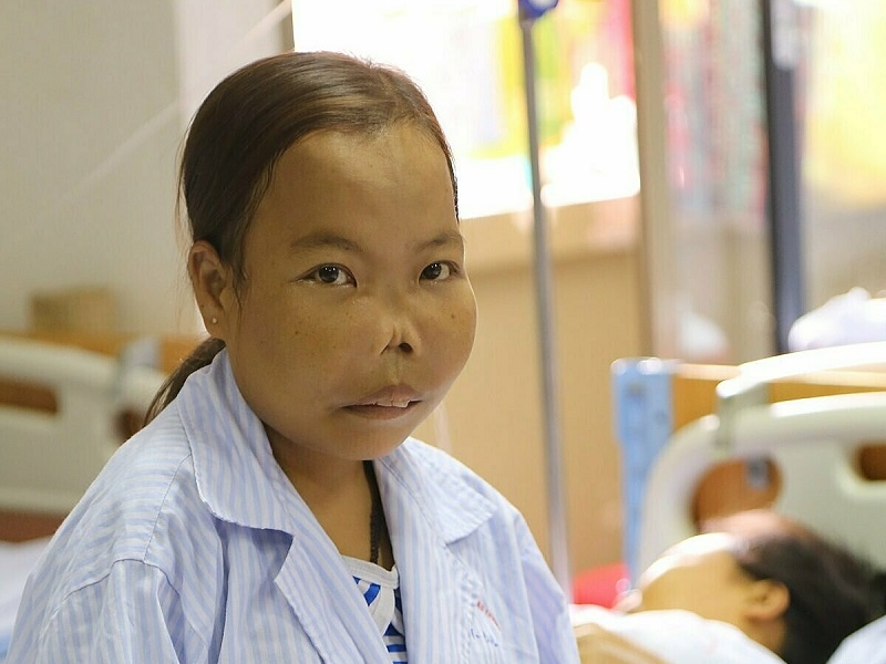 Thalassemia thể nặng có thể gây biến dạng xương mặt và loãng xương