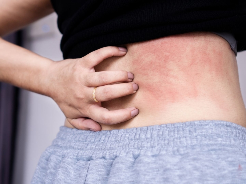 Sốc phản vệ không ưu tiên truyền dịch
