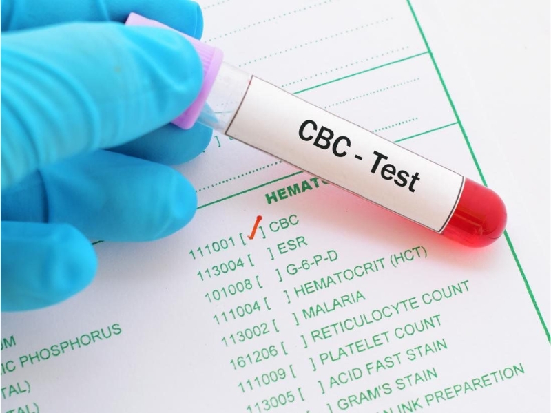 Xét nghiệm CBC giúp phát hiện thiếu máu ở người mắc Alpha Thalassemia