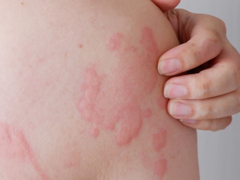 Sốc phản vệ biến chứng nguy hiểm khi truyền dịch gây khó thở tụt huyết áp cần cấp cứu ngay