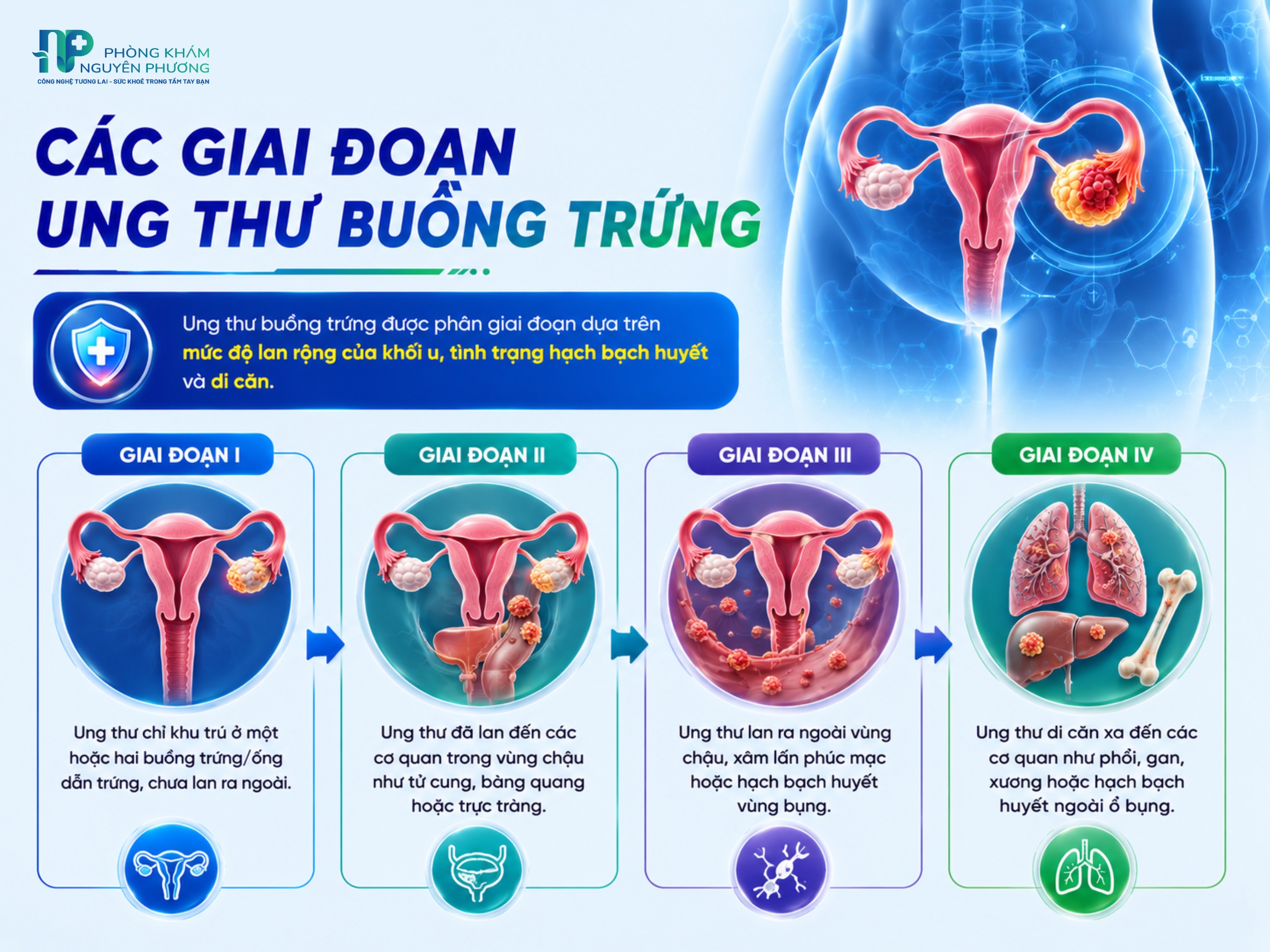 Các giai đoạn tiến triển của ung thư buồng trứng cần lưu ý