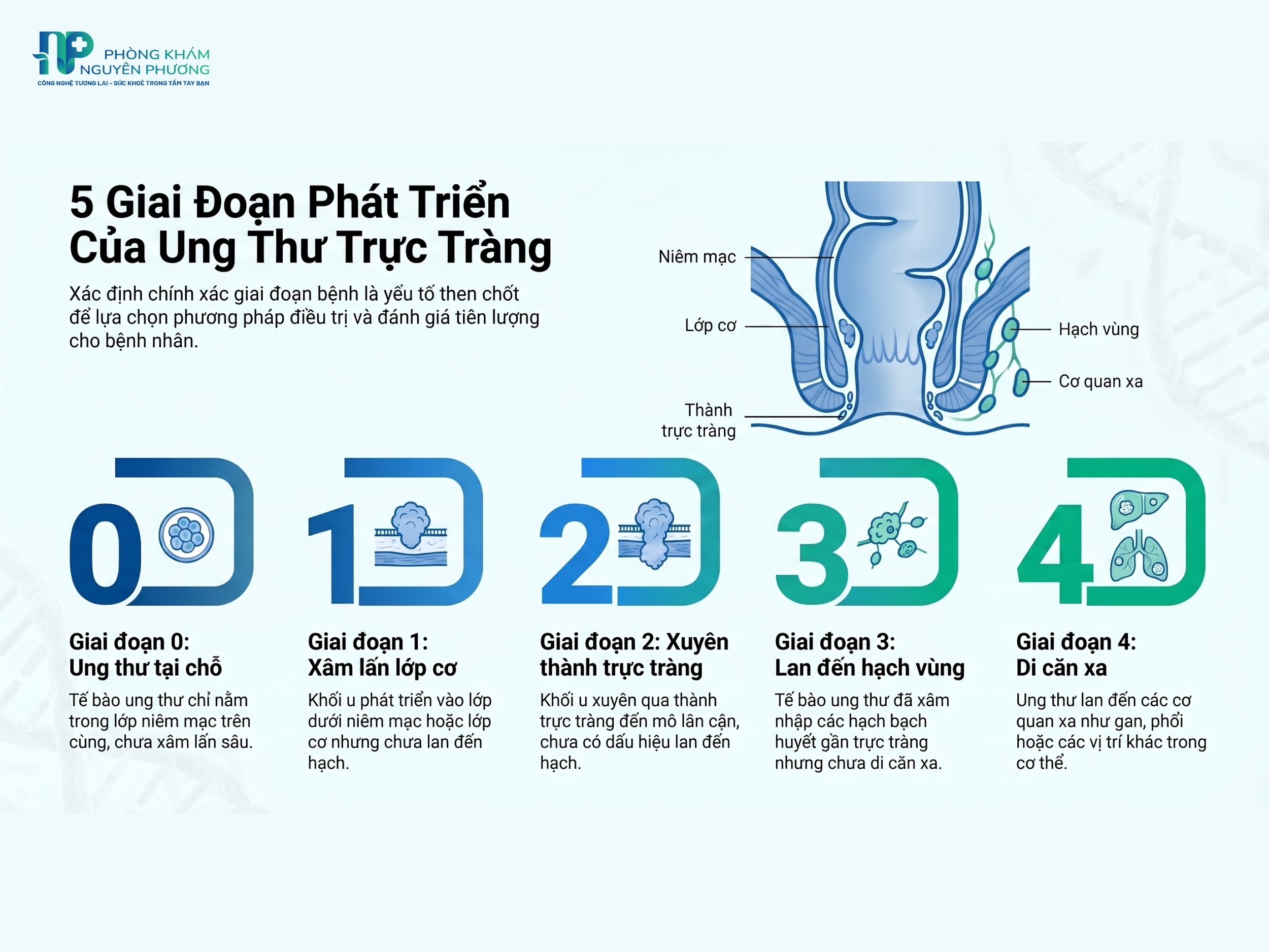 Các giai đoạn phát triển của ung thư trực tràng