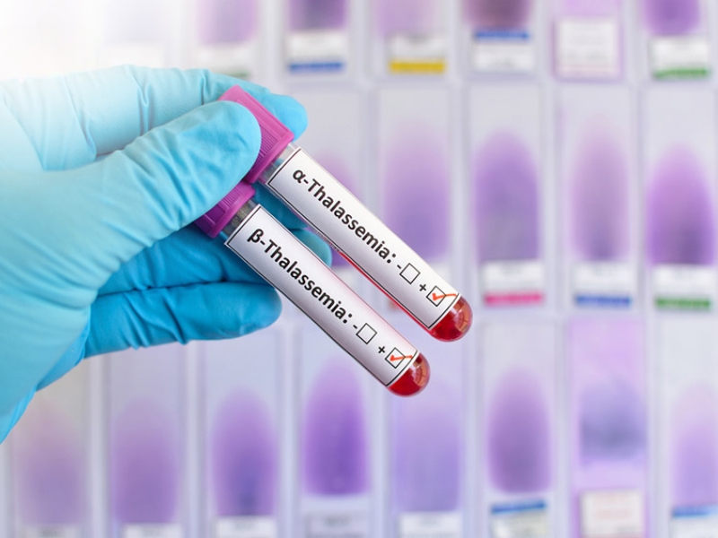 Alpha-thalassemia và Beta-thalassemia là hai dạng phổ biến của bệnh tan máu bẩm sinh