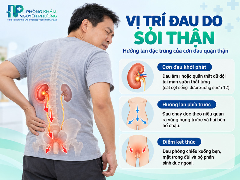 Sơ đồ vị trí đau đặc trưng do sỏi thận