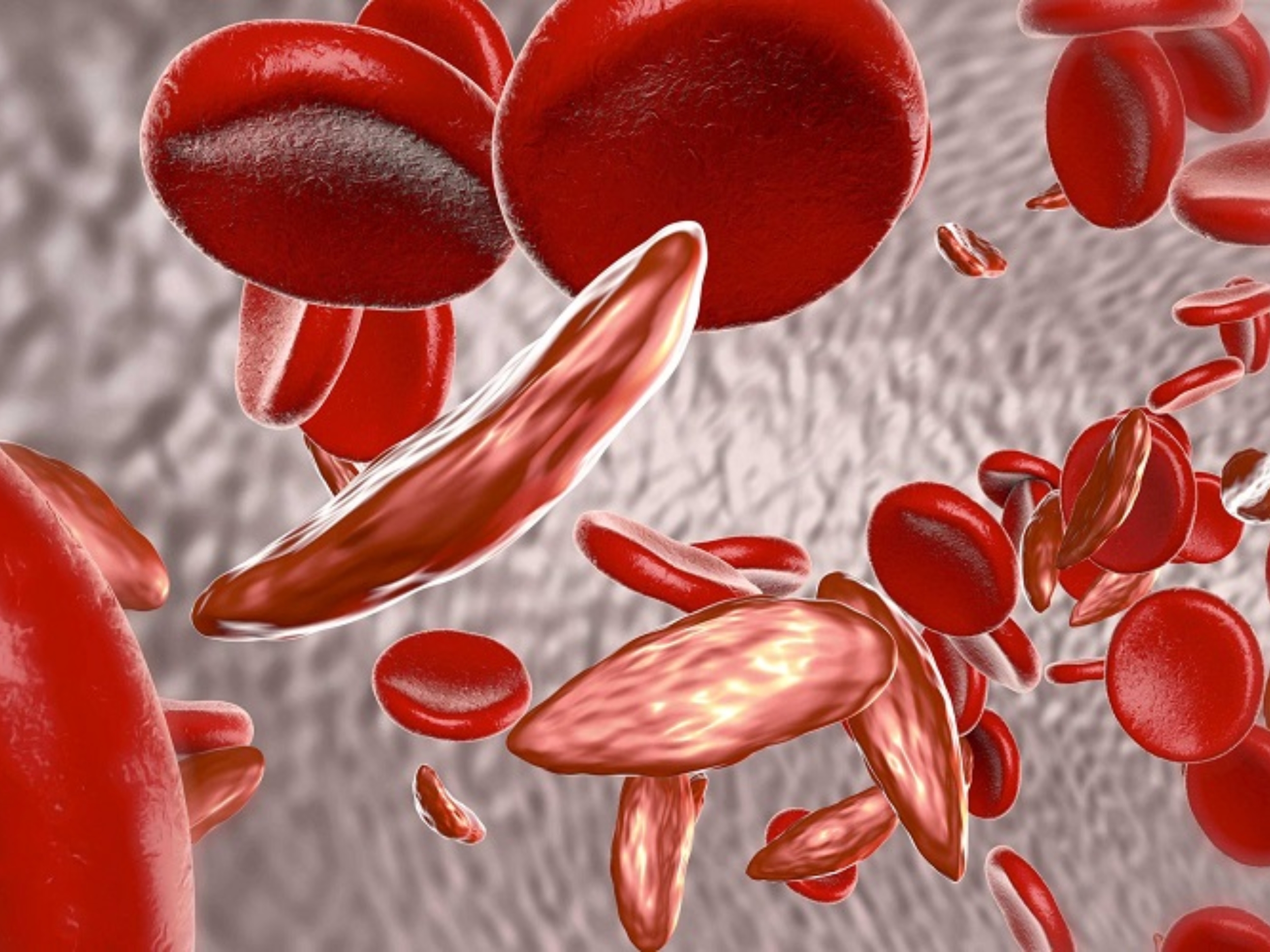Tan máu bẩm sinh là bệnh di truyền do rối loạn tổng hợp Hemoglobin khiến hồng cầu bị phá hủy sớm