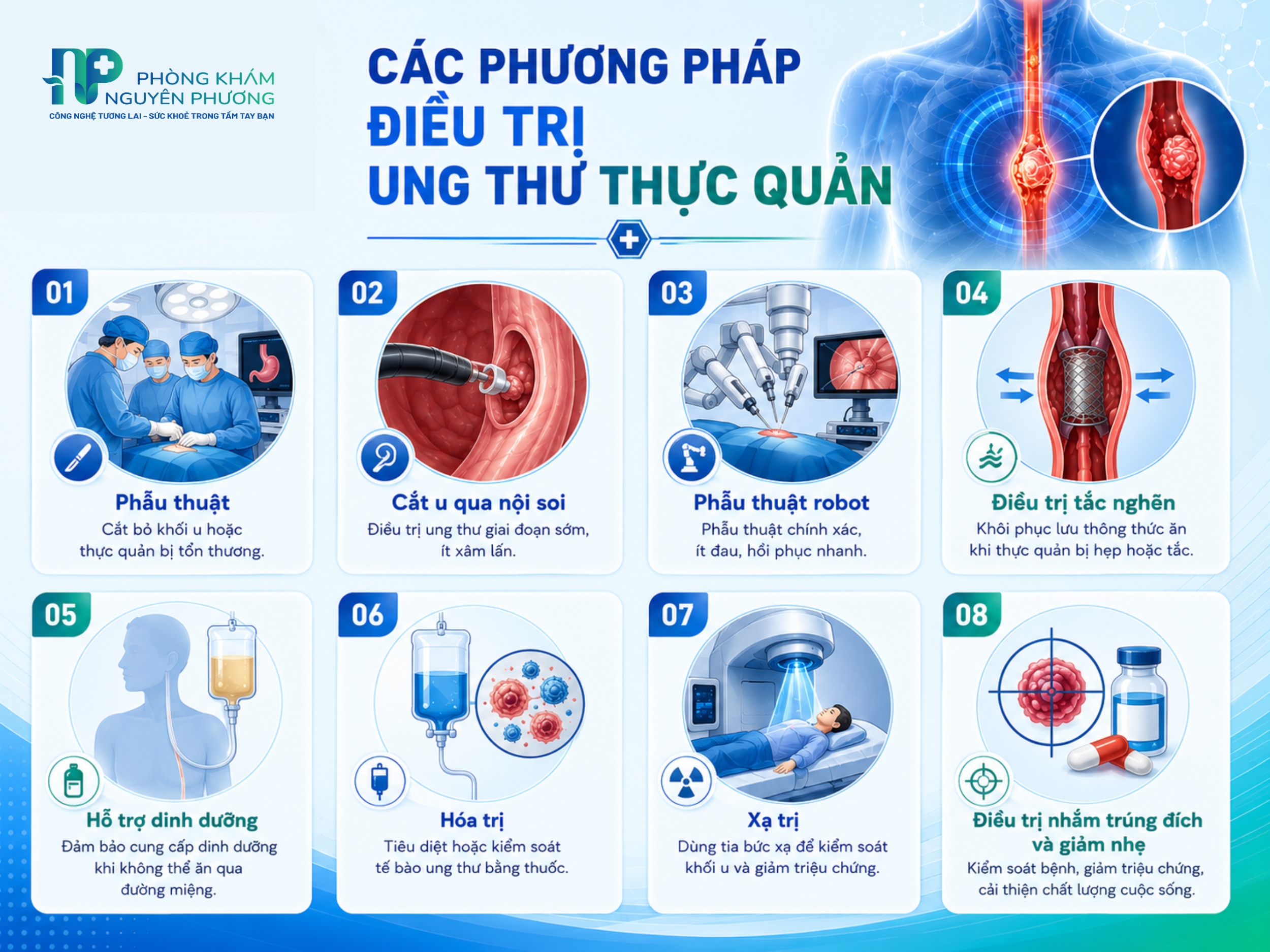 Các phương pháp điều trị ung thư thực quản theo từng giai đoạn bệnh