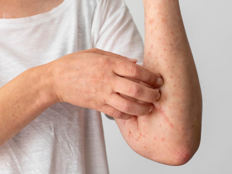 Sốc phản vệ không ưu tiên truyền dịch; cần tiêm adrenalin trước