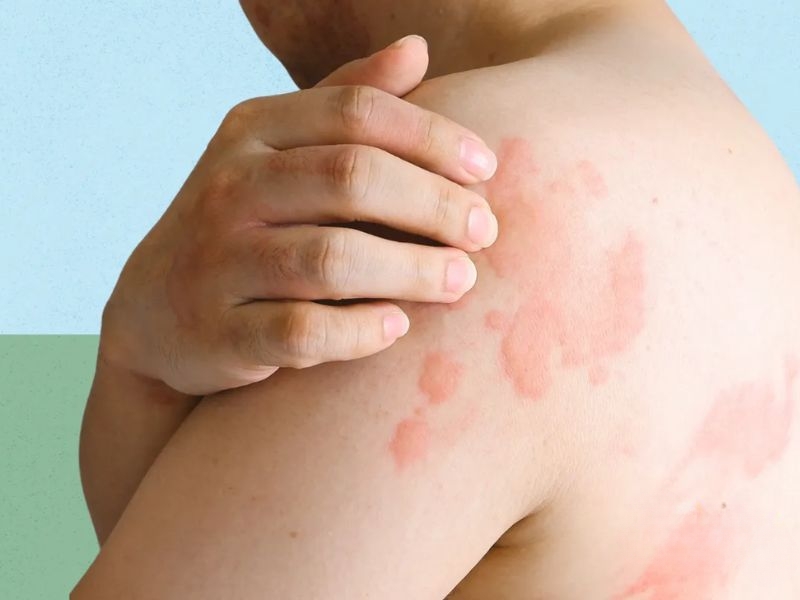 Khi truyền nước có thể gặp tác dụng phụ như sốc phản vệ