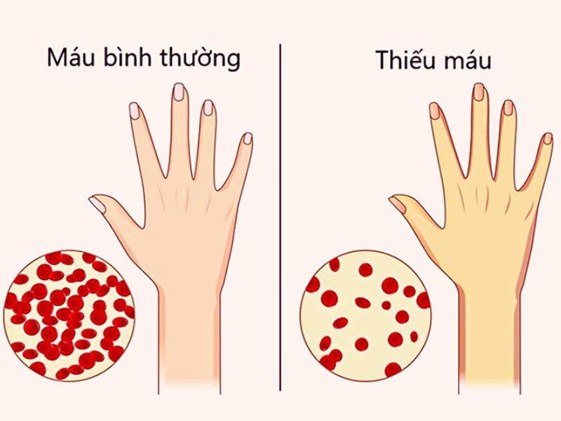 Thalassemia thể nhẹ thường ít triệu chứng, có thể gây mệt mỏi, da xanh xao và giảm huyết sắc tố