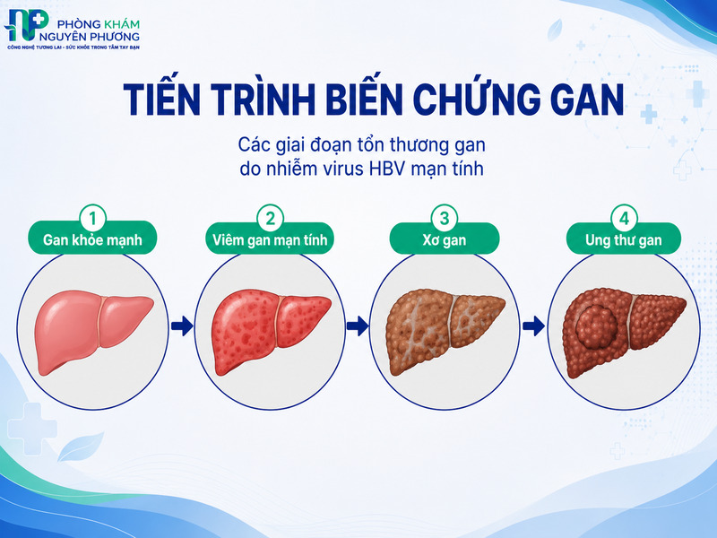 Diễn tiến âm thầm từ gan khỏe mạnh đến xơ gan và ung thư gan do virus HBV.